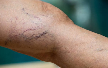 Exploring Non-Surgical Solutions for Varicose Veins