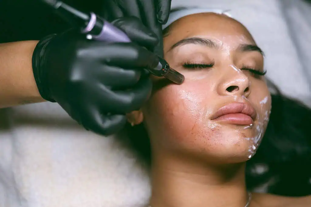 How Microneedling Works to Stimulate Collagen Production