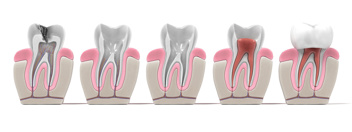 How Root Canal Treatment Can Save Your Smile and Your Tooth