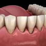 How Scaling and Root Planing Can Reverse Early Gum Disease