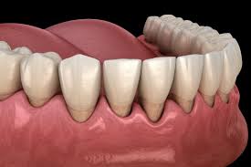 How Scaling and Root Planing Can Reverse Early Gum Disease