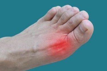 How a Podiatrist Treats Bunions and Calluses