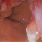 The Role of Technology in Improving the Esophageal Cancer Patient Experience