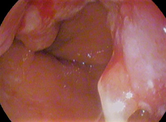 The Role of Technology in Improving the Esophageal Cancer Patient Experience