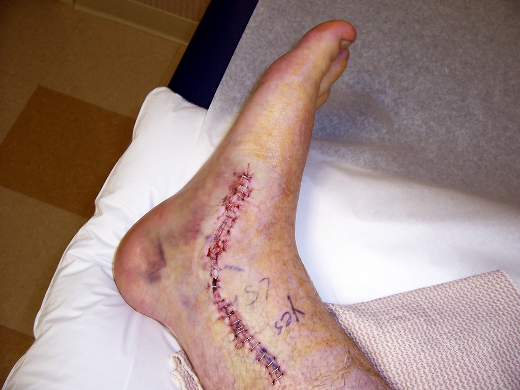 What You Should Know Before Considering Ankle Surgery