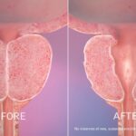 What to Expect During and After a UroLift Consultation