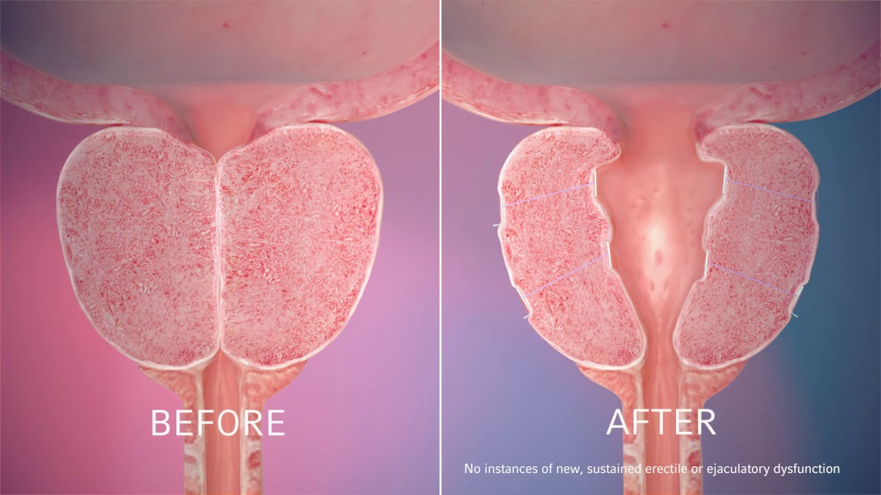 What to Expect During and After a UroLift Consultation