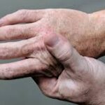 4 Common Types of Arthritis