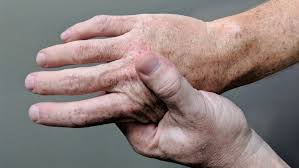4 Common Types of Arthritis