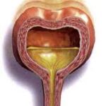 5 Types of Urinary Incontinence