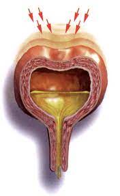 5 Types of Urinary Incontinence