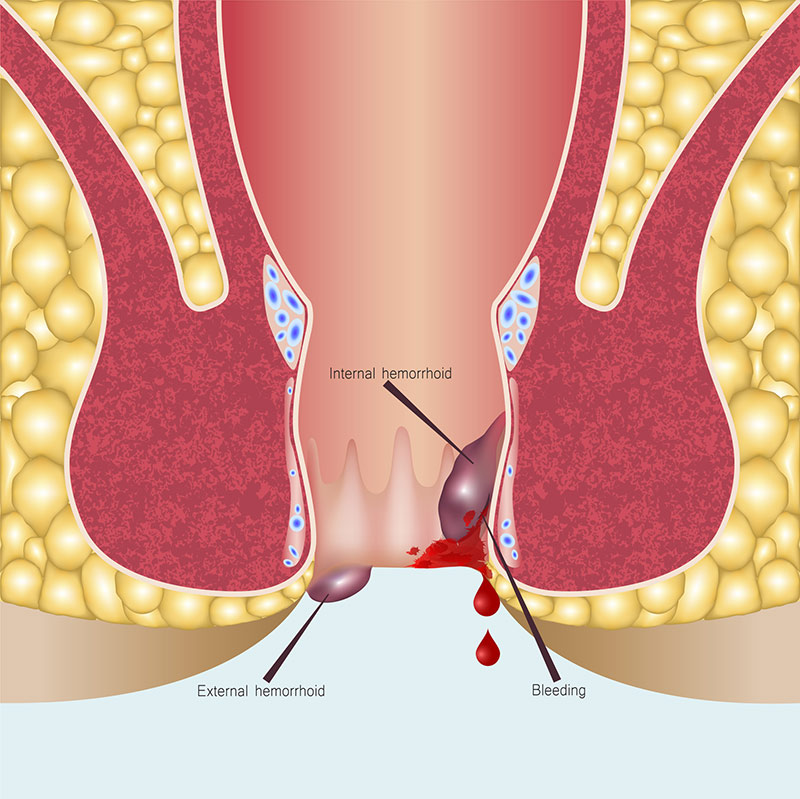 Debunking Myths About Hemorrhoid Embolization