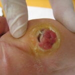 Diabetic Wounds: What You Need to Know