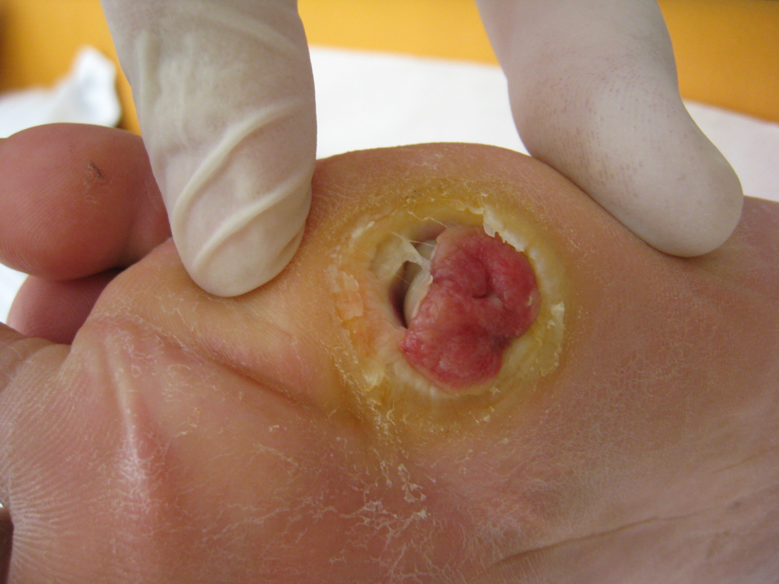 Diabetic Wounds: What You Need to Know