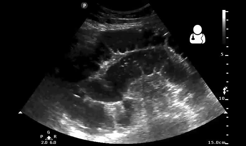How Ultrasounds Are Used for Assessing Abdominal Pain
