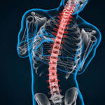 How a Herniated Disc Can Affect Your Lower Back