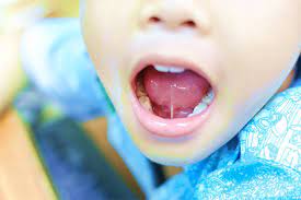 How to Diagnose and Treat a Tongue Tie Early