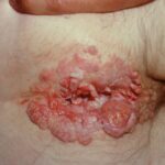 The Importance of Early Detection in Preventing Anal Cancer