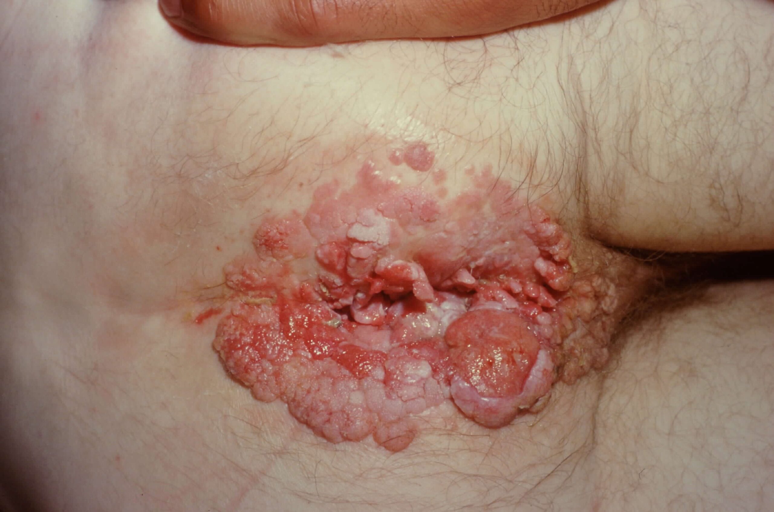 The Importance of Early Detection in Preventing Anal Cancer