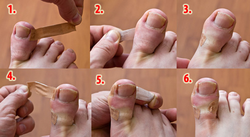Understanding Toenail Fungus and How Podiatrists Can Help