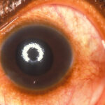 Understanding the Impact of Glaucoma on Your Eye Pressure