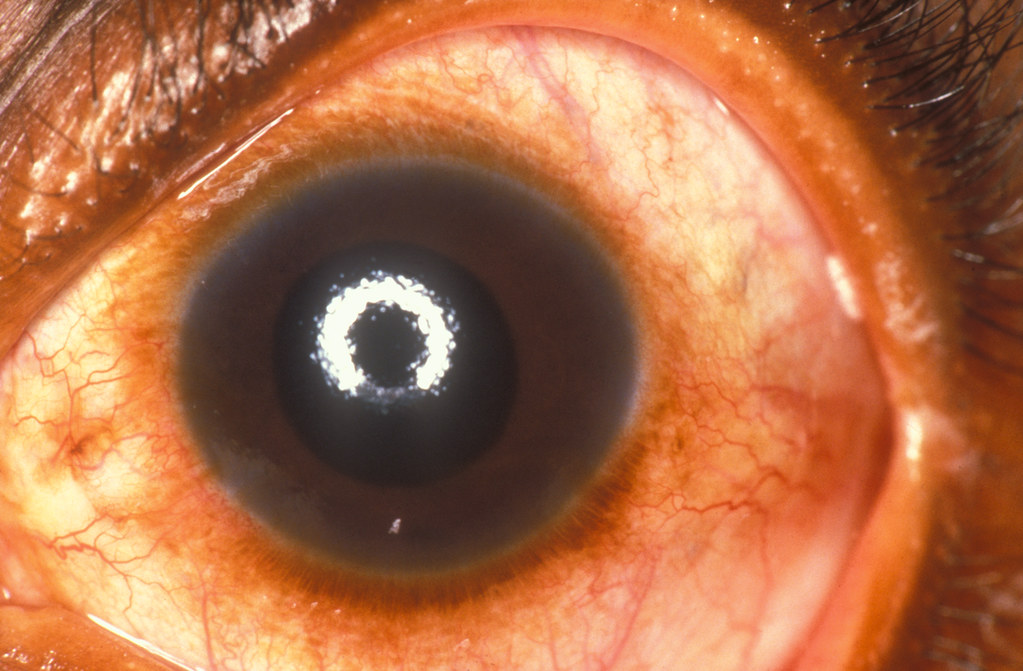 Understanding the Impact of Glaucoma on Your Eye Pressure