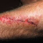 When To See a Vascular Specialist for Leg Wound Care