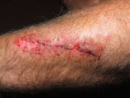 When To See a Vascular Specialist for Leg Wound Care