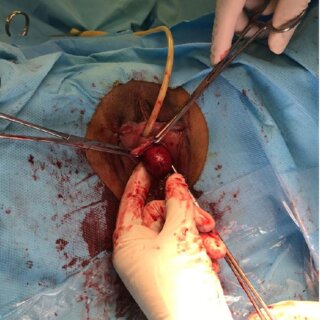 Finding Relief from Gallbladder Pain