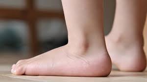 How Podiatry Can Help With Flat Feet and Fallen Arches