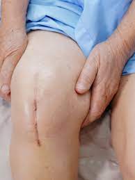 How Total Joint Replacement Can Restore Mobility