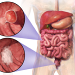 The Role of Follow-Up Care After Colon Cancer Surgery