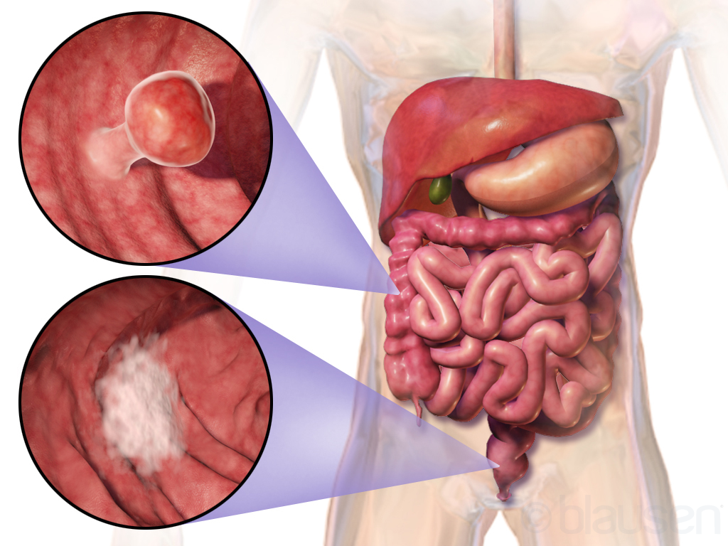 The Role of Follow-Up Care After Colon Cancer Surgery