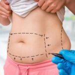 The Role of Liposuction in Body Contouring