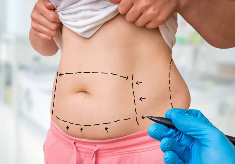 The Role of Liposuction in Body Contouring