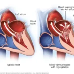 Treatment Options for Heart Murmurs
