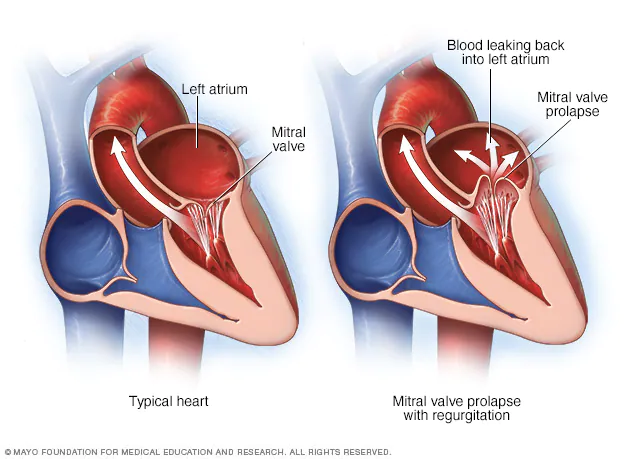 Treatment Options for Heart Murmurs