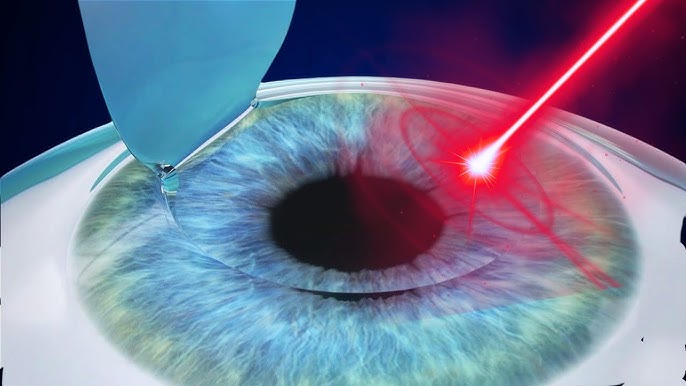 What Is LASIK Eye Surgery?
