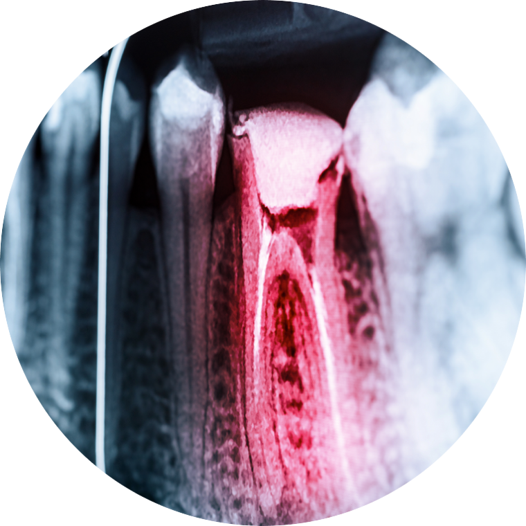 Why Do I Need a Root Canal?