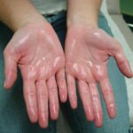 What Is Hyperhidrosis and How Can It Be Treated?