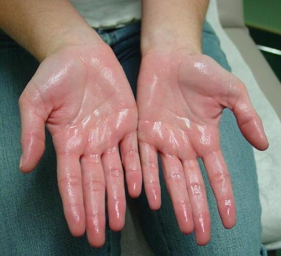 What Is Hyperhidrosis and How Can It Be Treated?