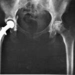 What to Expect During Hip Replacement Surgery