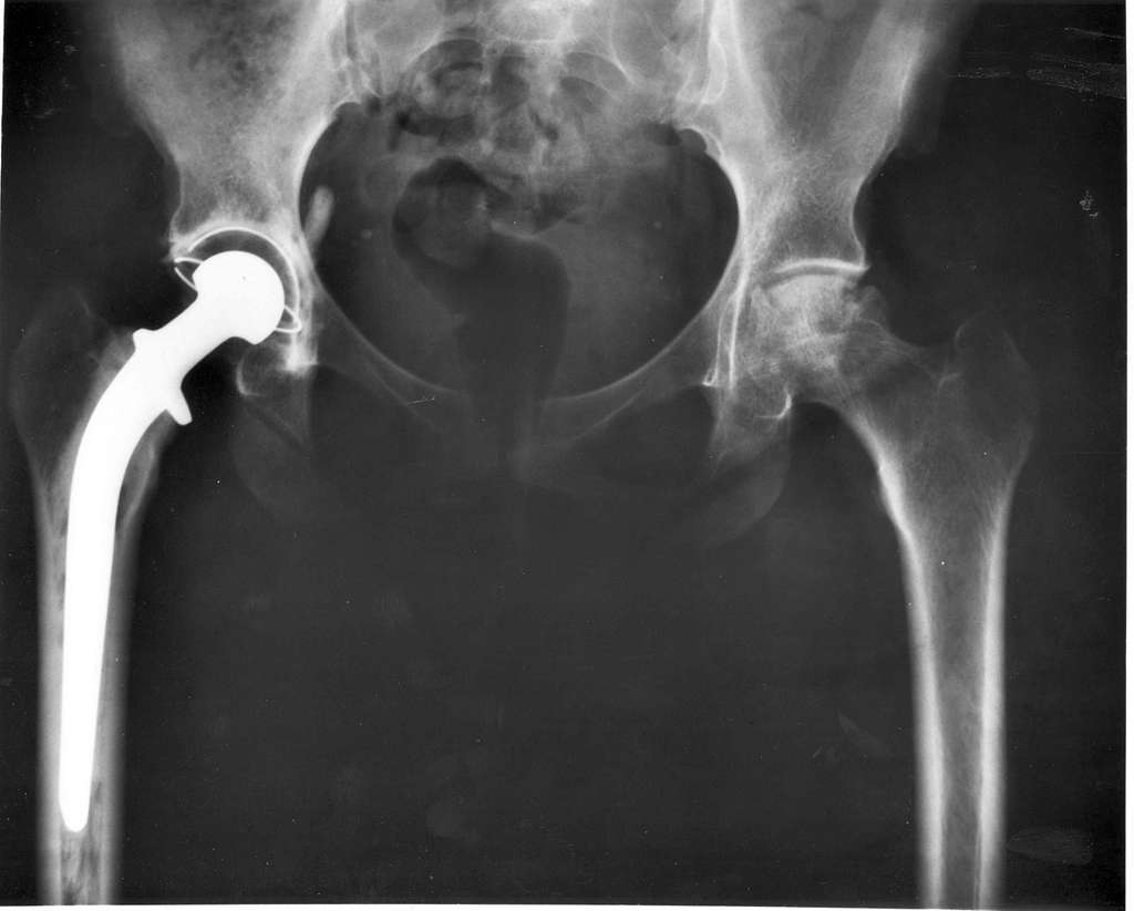 What to Expect During Hip Replacement Surgery