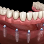 How Dental Implants Are Changing Smiles for a Lifetime