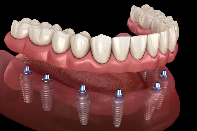 How Dental Implants Are Changing Smiles for a Lifetime