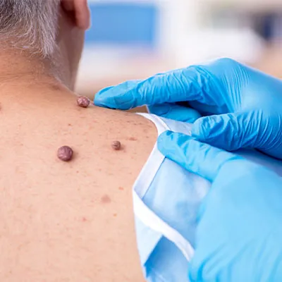 How To Identify and Manage Sebaceous Cysts