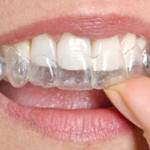 Clear Aligner Therapy for a Confident Smile