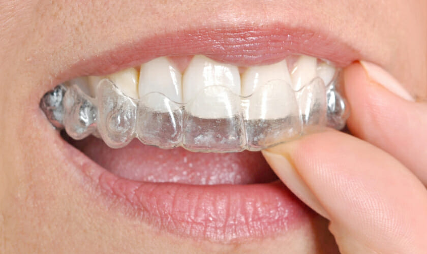 Clear Aligner Therapy for a Confident Smile