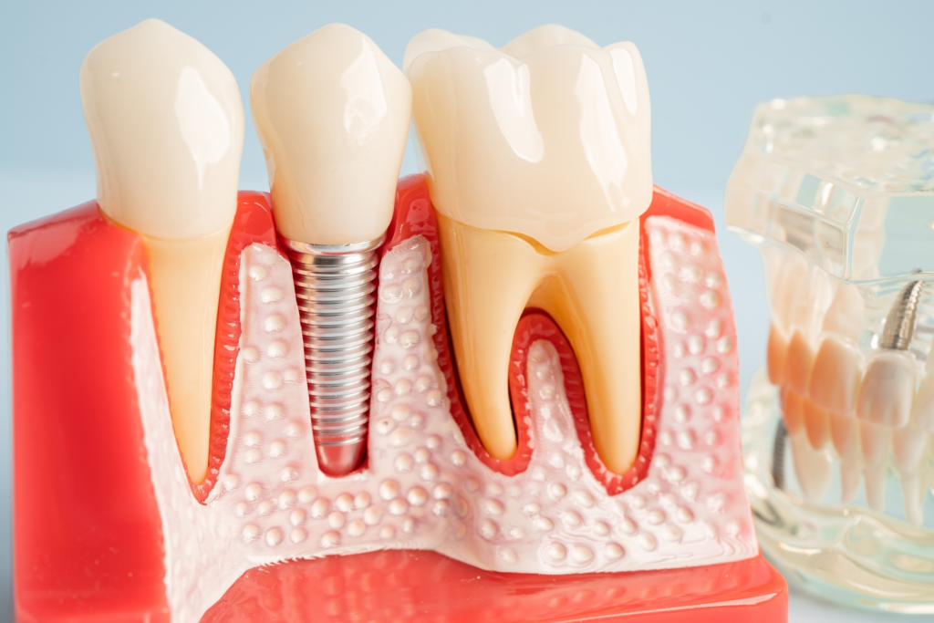 Dental Implants: A Modern Solution for Missing Teeth