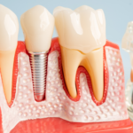 Dental Implants: A Modern Solution for Missing Teeth